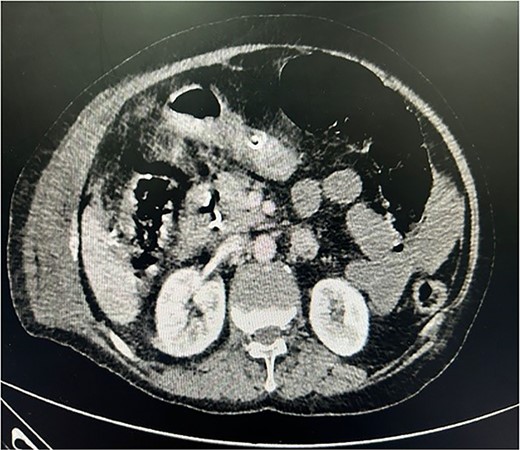 CECT whole abdomen of the patient post laparoscopic cholecystectomy