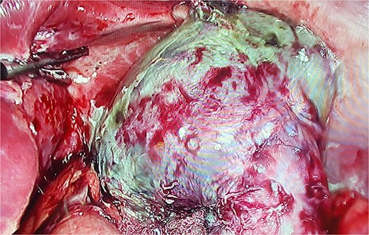 Laparoscopy, gastric remnant is seen with necrosis and purulent fluid.