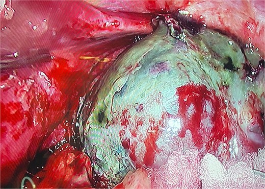 The gastric remnant is seen with necrosis and dissected from the spleen.