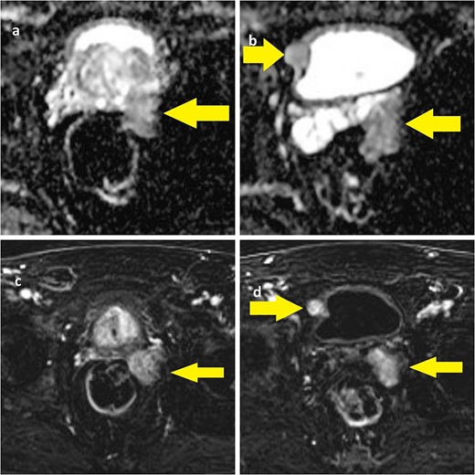 (a) ADC-weighted MRI showing left prostate lobe and left seminal vesicle lesion; (b) T1-weighted MRI showing left seminal vesicle and right paravesical lesion; (c, d) T1-weighted MRI with same lesions.