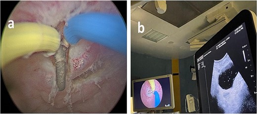 (a) Endoscopic vision during resection. (b) Endoscopic and ultrasound contemporary vision of the lesion.