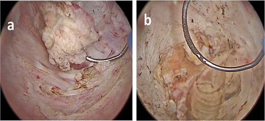 (a, b) Bladder lesion appearing as a nodular intravesical mass, in contrast with typical urothelial bladder cancer, which are commonly endoluminal.