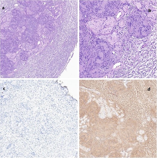 (a) Schwannoma (20×); alternating compact Antoni A areas (center) with nuclear palisades, known as Verocay bodies and loose Antoni B (periphery) areas. Note some characteristic hyalinized blood vessels. (b) Schwannoma (40×). No mitosis, nuclear atypia or necrosis are seen, in accordance with the benign nature of the neoplasm. (c) Very low proliferation index (Ki67); scattered positive cells. (d) Diffuse positive immunoreactivity for S100.