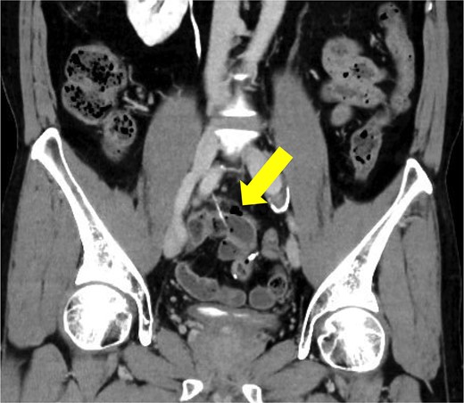 Contrast-enhanced computed tomography before surgery. A sharp foreign body with bowel perforation was identified in the ileum. Free air was localized in the mesentery and no abscess formation was observed.