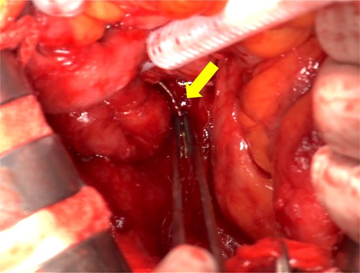 Intraoperative findings. Severe adhesions of the small intestine were observed and a sharp 4 cm foreign body was located 15 cm proximal to the terminal ileum penetrating the mesentery through the ileal wall (arrow).