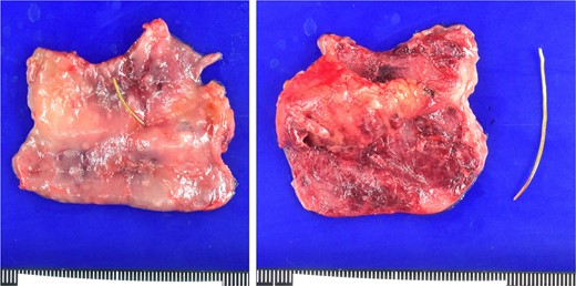 Macroscopical findings. Approximately 5 cm of the small intestine, including the perforation site, was resected. The foreign body was confirmed to be a fish bone.