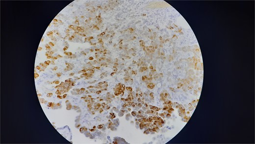 Shows that the neoplastic cells are strongly and diffusely positive for Ck5/6 (membranous and cytoplasmic staining).
