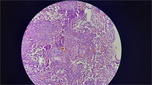 Shows that invasive proliferation of atypical mesothelial cells with large hyperchromatic nuclei with tubulpapillary and solid growth pattern.