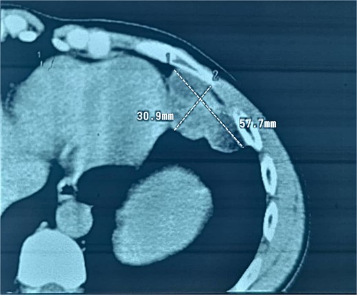 CT scan in axial view showing the lesion.