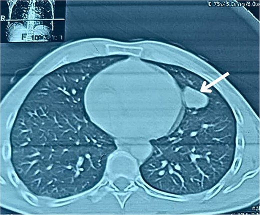 CT scan in axial view showing the lesion.