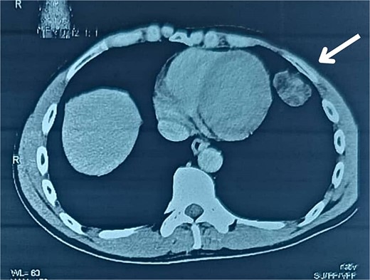 CT scan in axial view showing the lesion.