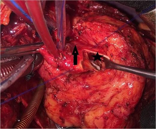 Intraoperative image showing the opened aorta. The arrow points to the aortotomy, and the star points to the stenotic left ventricular outflow tract through the aortic orifice.