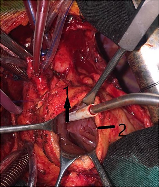 Intraoperative image showing the right ventriculotomy (2) and the conal papillary muscle (1).