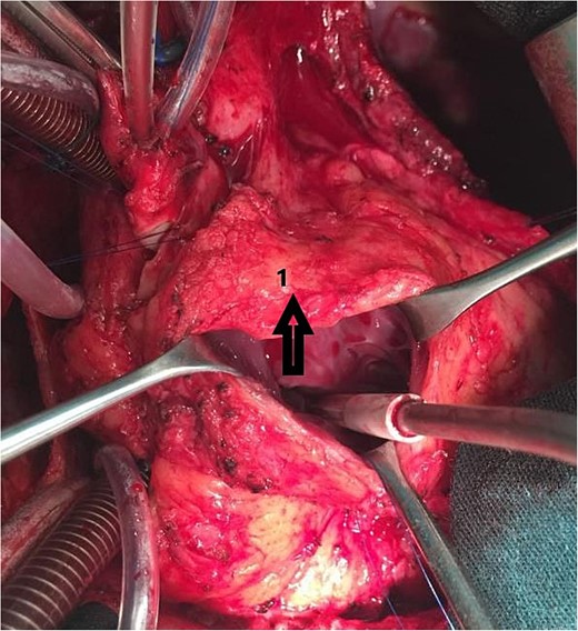 Intraoperative image showing the septal incision (1).