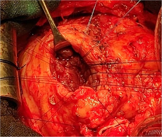 Intraoperative image showing the interrupted sutures placed around the septal incision.