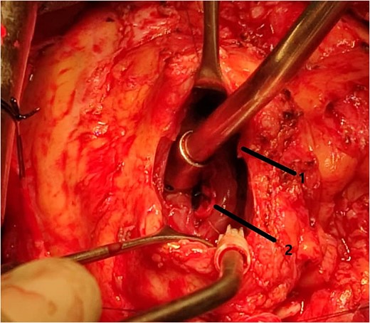 Intraoperative image showing the bovine pericardial patch used to close the septal incision. (1) Right ventriculotomy and (2) bovine pericardial patch.