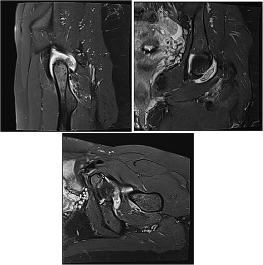 MRI is observed in axial, sagittal, and coronal sections, showing the presence of an intra-articular lesion and abundant synovitis.