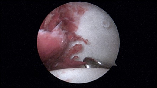 Arthroscopy image showing a large intra-articular lesion.