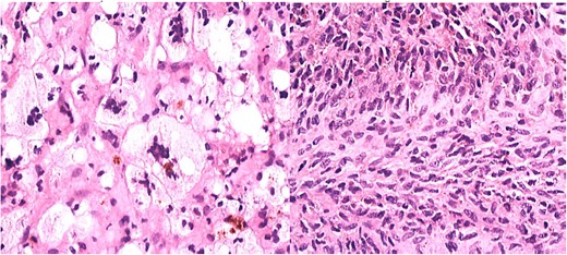Histopathology showing proliferation of mononuclear synovial cells with oval or polygonal shapes and multinucleated giant cells resembling osteoclasts.