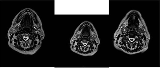 MRI with the contrast medium which highlighted the presence of an ovoid expansive process of ⁓15 mm in diameter with undefined margins compared to the surrounding glandular parenchyma. The lesion was characterized as an area with a non-homogeneous signal for T2 iso-hyperintensity and T1 iso-hypointensity with equally heterogeneous enhancement after administration of the contrast medium.