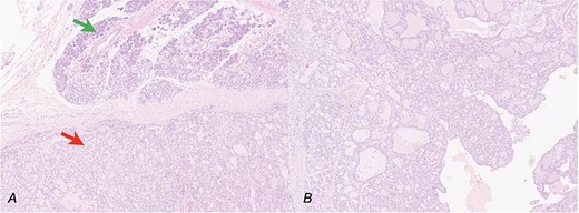 Secretory carcinoma of the salivary gland H&E stained section (10HPF). (a) Transition point between normal salivary gland tissue (upper arrow) and neoplastic tissue (lower arrow). (b) Some architectural details of neoplasia: Solid, glandular, and cystic areas and papillary extroflections.