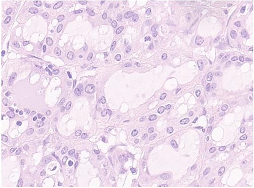 Secretory carcinoma of the salivary gland H&E stained section (40HPF). Tumors aggregate with solid and glandular structure compound of neoplastic cell with eosinophilic vacuolated cytoplasm and monomorfic round vescicular nucley with small nucleoly.