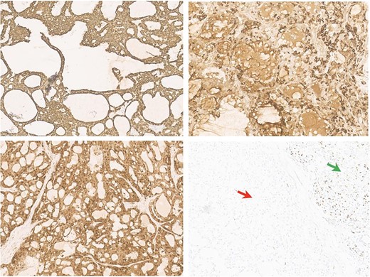 Antibodies inmunohistochemical neoplasia panel (10HPF). (a) Intense membrane cycheratin 7 staining of the neoplastic cell. (b) Citoplasmatic and membranes mammoglobin staining of the neoplastic cell. (c) Diffuse citoplasmatic and nuclear S100 staining of the neoplastic cell. (d) The possibility of the p63 antibody staining in the normal salivary gland tissue (right arrow) and negativity of neoplastic population (left arrow).
