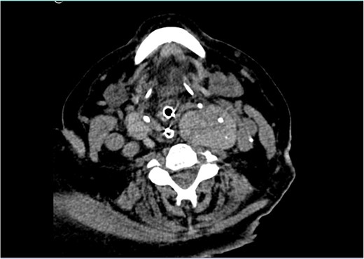 Neck CT showing a large goitre with extension to the left angle of the mandible.