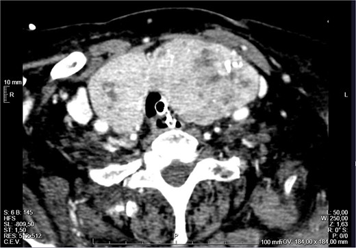External compression of the thyroid and larynx by the mass with narrowing of its lumen.