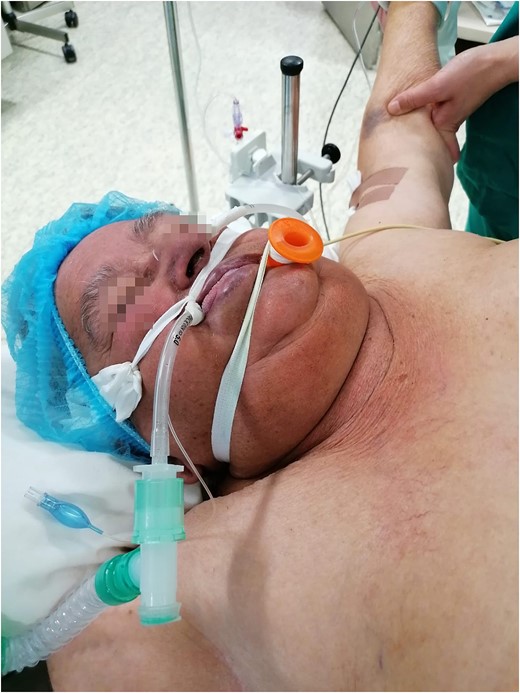 Positive Pemberton sign.