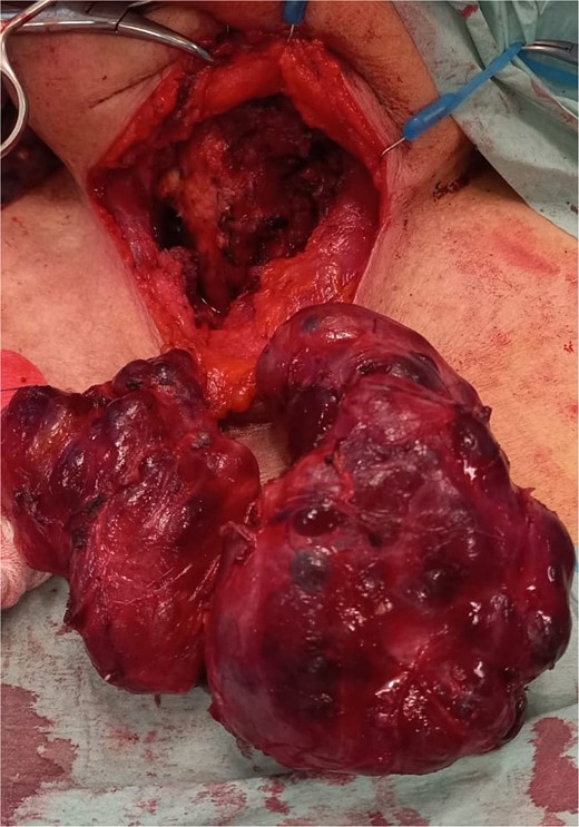 Surgical specimen after total thyroidectomy.