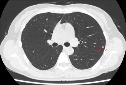 Computed tomography revealed a solitary pulmonary nodule (circle) in the left upper lobe 6 months after uterine surgery.