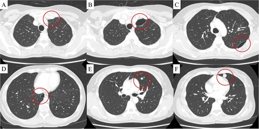 (A) Computed tomography revealed a bulla in the left upper lobe 1.5 years after uterine surgery. At 3 years, in addition to the development of the bulla in the left upper lobe (B), two more bullae appeared and gradually developed in the left (C) and right lower (D) lobes, and two pulmonary metastases appeared in the left lingular segment (E, F). The findings are indicated by circles.