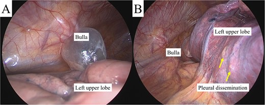 Intra-operative findings revealed a bulla in the apex of the left lung (A) and pleural dissemination (B, arrows).
