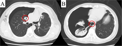 Computed tomography revealed a pleural dissemination nodule in the right hilar area (A) and a bulla in the right lower lobe (B). The findings are indicated by circles.