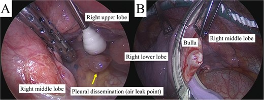(A) Intra-operative inspection revealed a large pleural dissemination nodule in the right hilar area with an air leak (arrow), which was resected. (B) The bulla in the right lower lobe with no air leak was also resected.