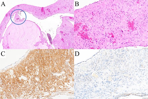 (A, B) Pathological examination revealed tumor cells in the wall of the resected left bulla. A vascular structure was observed in the bulla (A, circle), indicating that the bulla developed by retraction and collapse of the surrounding alveoli. The tumor cells were immunohistochemically (C) positive for smooth muscle actin and (D) negative for human melanoma black 45, ruling out LAM and Birt–Hogg–Dubé syndrome.