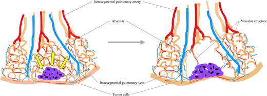 Tumor cells reduced the flexibility of the surrounding alveoli, causing local hypertension and traction (arrow). The mechanical force destroyed some alveolar walls and led to bulla formation, while more robust vascular structures survived within the bulla.