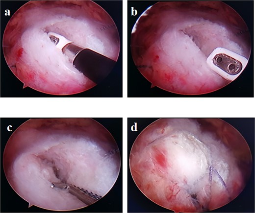 (a,b) Split the tendon lengthwise along the tendon fibers on the side of the bursae. (c) A side-to-side suture is performed after implantation of an inner row anchor. (d) The situation after the suture of the double-row anchors.