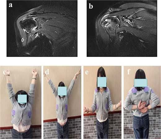 (a): Pre-operative MRI showed PASTA lesions. (b) The MRI showed good repair at 3 months postoperative follow-up. (c–f) The function of anterior flexion, abduction, external rotation and internal rotation 3 months postoperative follow-up.
