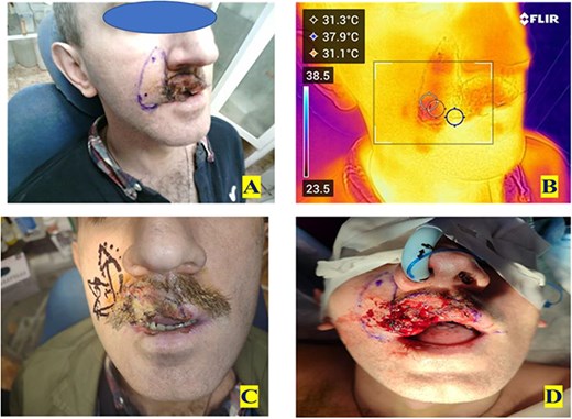 Preoperative images. (A) Skin marking identifying the proposed rotational skin flap. (B) Pre-op DDT, the darker shading represent ‘hot spots’ that indicate the location of perforating vessels. (C) Skin marking indicating the proposed flap immediately prior to surgery. (D) Close up view of the wound, note the blue dots marking the vessels identified on DDT.