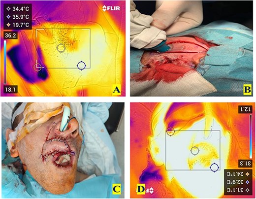 Intra-operative images. (A) The view given by intra-operative DDT to help identify the superior labial artery. (B) Handheld audio Doppler used to confirm the presence of the superior labial artery within the rotational flap. (C) Rotational flap in situ after suturing in position. (D) DDT view at the end of the operation showing equal temperature indicating good perfusion.