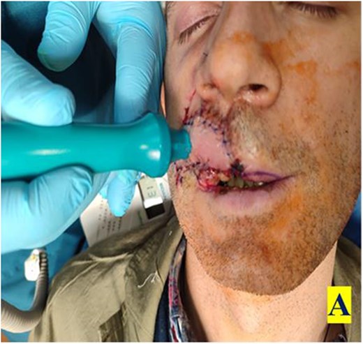 Postoperative Day 1, demonstrating the use of handheld audio Doppler.