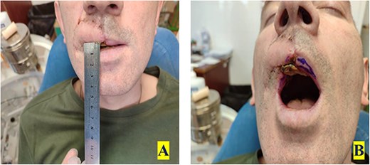Postoperative Day 7, after removal of sutures. (A) Showing anterior view and (B) showing inferior view.