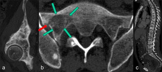 In the sagittal reformation of the right hip (a), in the axial CT section of the right ilium (b) and in the sagittal reformation of the spine (c) osteoblastic metastases of the known prostate carcinoma are visible. In (b), there is also an osseous defect zone (marked with green arrows) in the right lateral mass of the sacrum with a pathological fracture (marked with red arrow) in the area of the lateral cortical border.