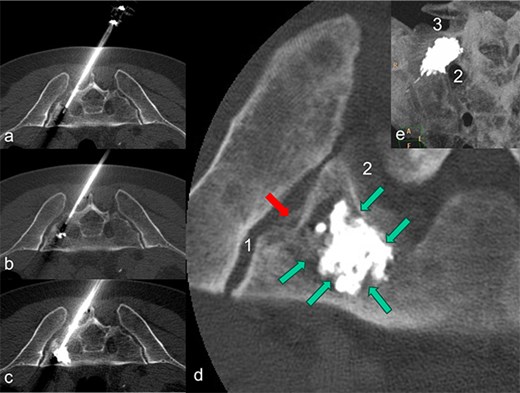 The patient is lying prone in the CT. The needle of the application system (a) was inserted from the dorsal side via the short axis. During the cement insertion, the successive, discontinuous filling of the metastasis-related defect zone in the right lateral mass of the sacrum is shown in (a) to (b). The highly viscous cement activated by radio frequency enables precise augmentation while simultaneously blocking a leak. In (d), the inserted PMMA cement is placed centrally in the defect zone as a cement seal (marked by green arrows); there is no cement leakage through the pathological fracture (marked by a red arrow) in the direction of the sacroiliac artery (1) and the neuroforamen (2). A MIP-reformation (d) shows the cement filling, whereby here too there is no leakage in the direction of the neuroforamen (2) and the adjacent disc space (3).