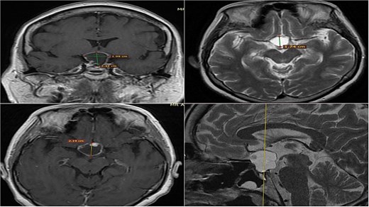 MRI of sellar region tumor in contrasted T2 and T1 sequences in axial, coronal and sagittal sections.