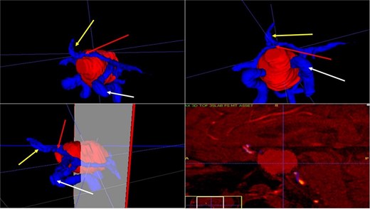 3D reconstruction through manual planimetric segmentation of the tumor and its vascular relationships. White arrow, left internal carotid artery. Yellow arrow, anterior cerebral artery segment A2. Red arrow, anterior communicating artery.