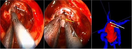 Surgical images. White arrow, anterior communicating artery. Yellow arrow, tumor capsule.