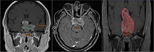 Contrast-enhanced T1 MRI of pituitary marcoadenoma. Multiplanar conventional geometric volumetry.